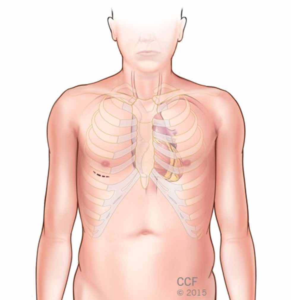 minimally invasive and robotically assisted heart surgery 3.png